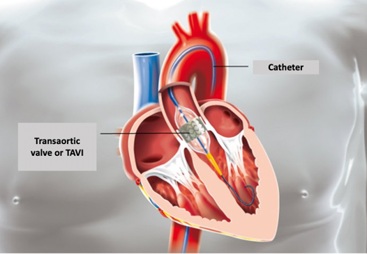 tavi procedimento minimamente invasivo salvar vidas